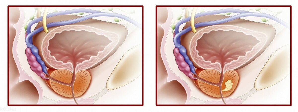 前列腺炎疼痛是哪里疼,前列腺炎引起哪里疼