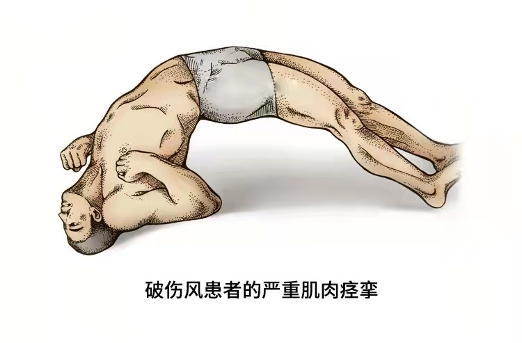 破伤风的特异性防治,破伤风特异性抗原