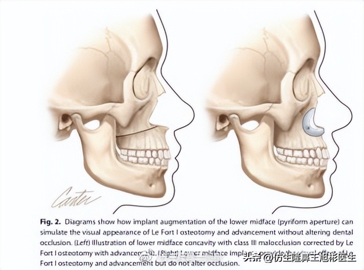 鼻基底填充会移位到鼻孔吗,鼻基底填充假体会拉长人中吗