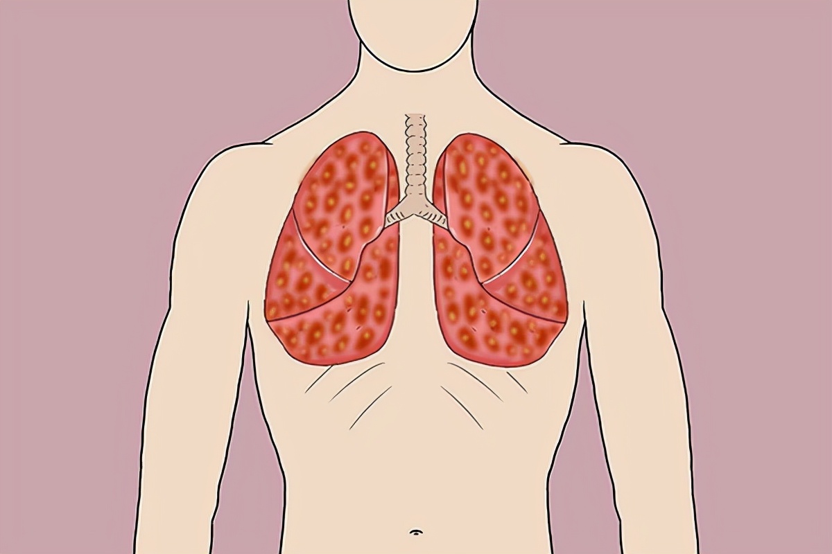 背痛和肺癌的早期症状及表现,背痛和肺癌