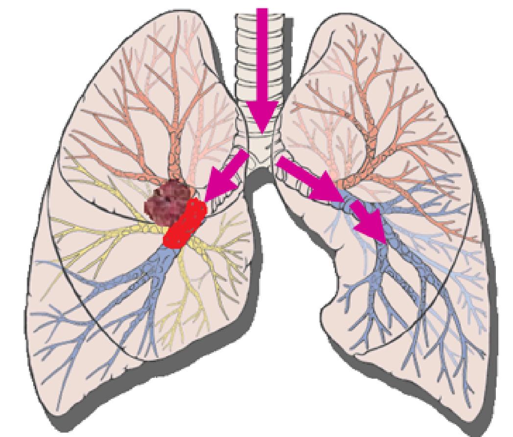 咯血一定要做支气管镜吗,支气管镜的注意事项