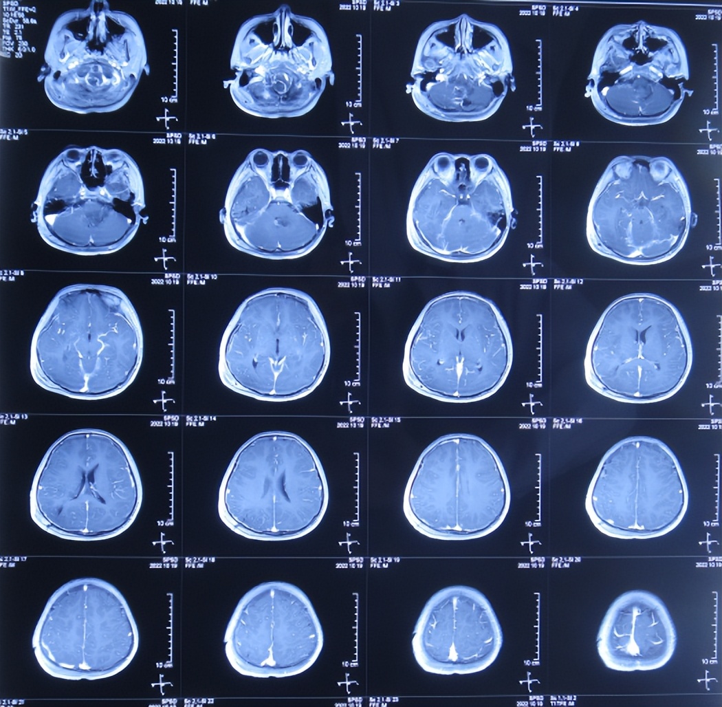 脑干出血儿童,儿童脑干胶质瘤呕吐