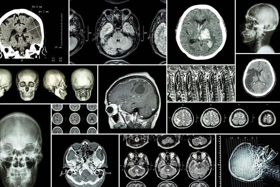 短暂性脑缺血发作应该怎么应对呢,短暂性脑缺血反复发作怎样办