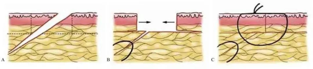 3分钟get:真正的外科缝合秘籍