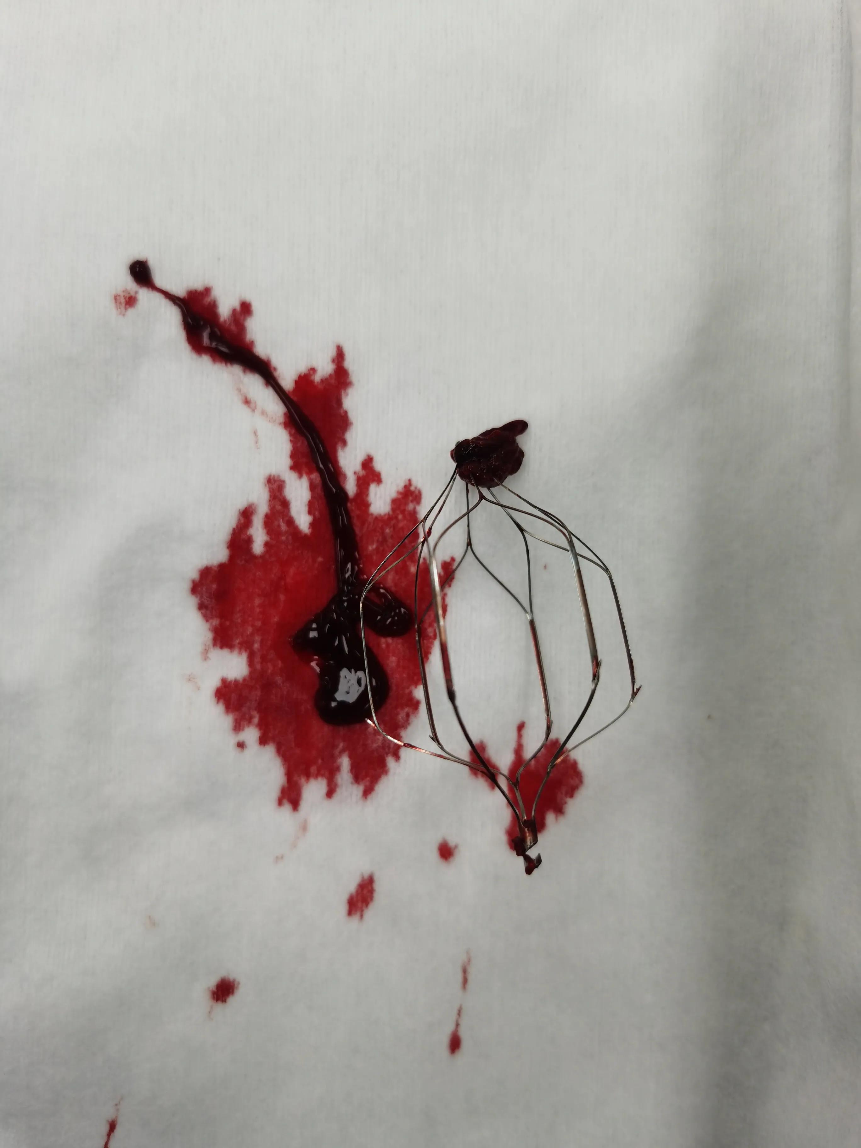 病人腿肿如何消除,病人腿肿了怎么回事