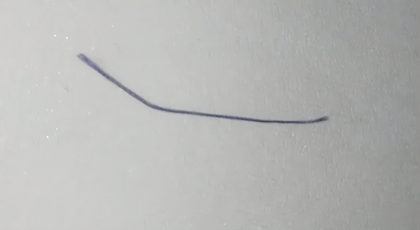 女孩痔疮手术操作,痔疮手术11天的真实经历