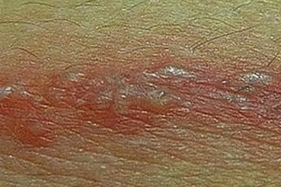 带状疱疹又叫“缠腰蛇”，该怎么治？医生：这10类人易被盯上！