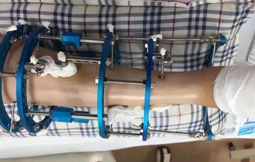 李亚诺中国断骨增高第一人,当年花16万断腿增高