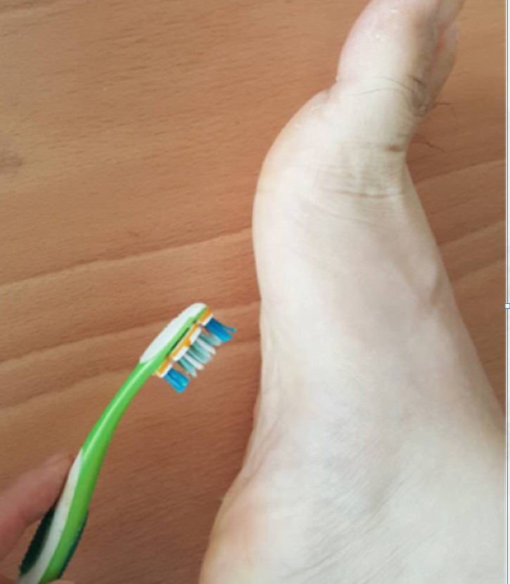 小孩子多大需要干预扁平足,8岁女孩扁平足需要干预吗