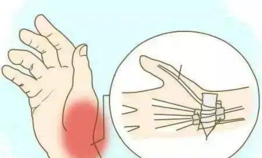 85岁关节疼痛针灸治疗有用吗,手关节处疼痛针灸