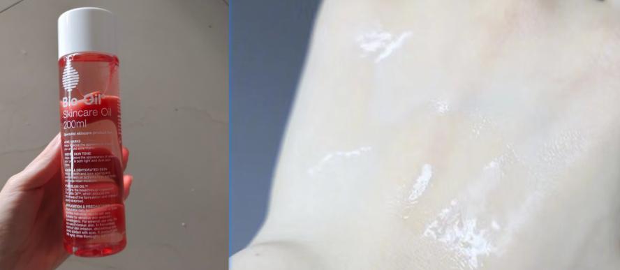 消除妊娠纹是不是智商税,去除肥胖纹妊娠纹产品