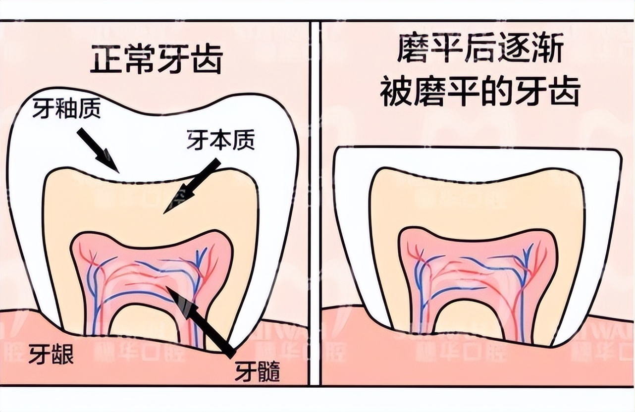 睡着磨牙齿是什么原因怎么治疗,磨牙牙齿变黑是怎么回事