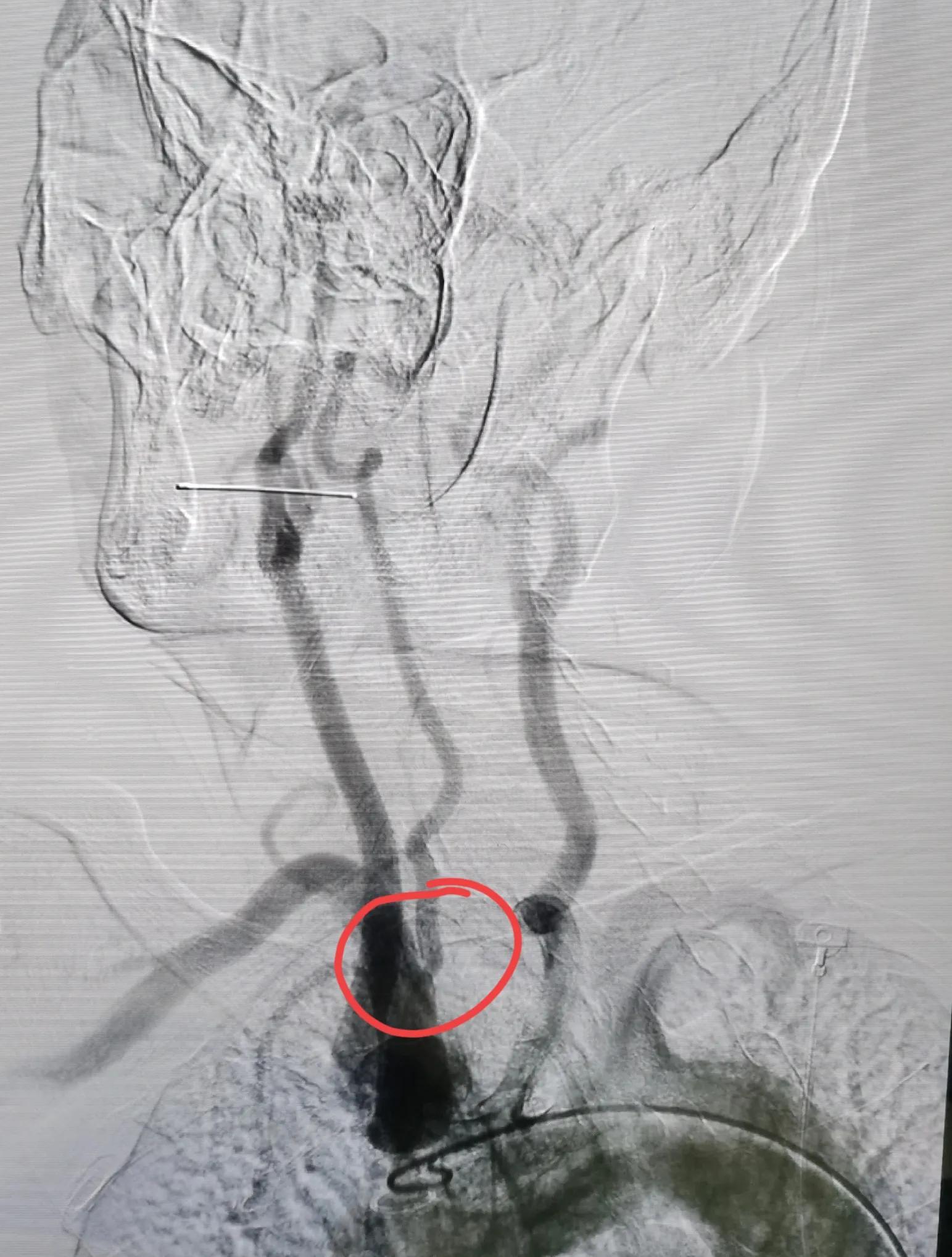 一例头晕，眼睛看东西模糊患者的会诊