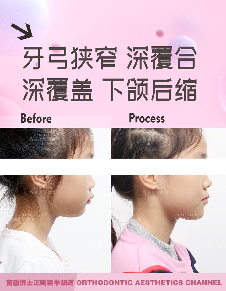 儿童反颌矫正完嘴凸,儿童下颌后缩嘴凸矫正需要多久