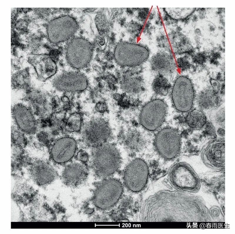 又解锁新功能？猴痘病毒可通过飞沫传播了……