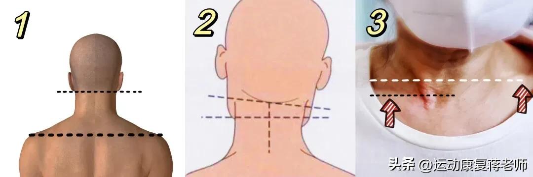 脖子歪左边怎么矫正,脖子歪了睡觉应该注意啥姿势