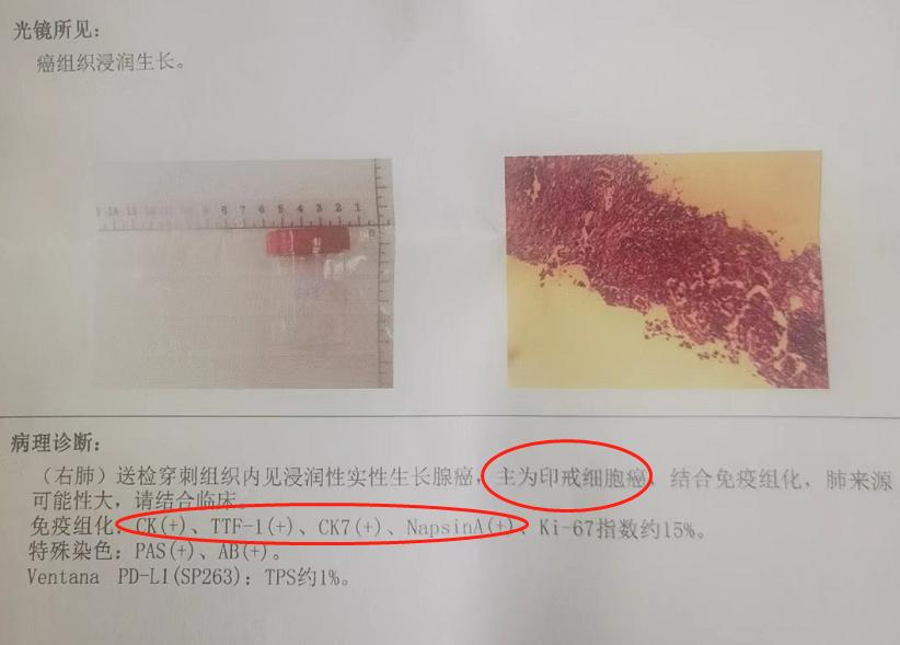 胸腺鳞状细胞癌手术后两年肺转移,胸腺鳞癌转移了能活多久