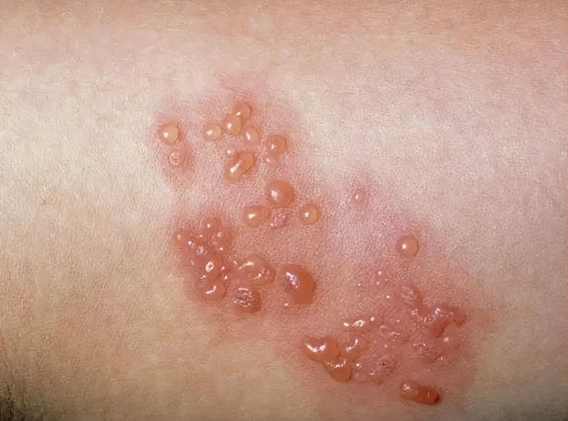 真菌清热除湿的口服中成药,细菌性皮肤病的常用药