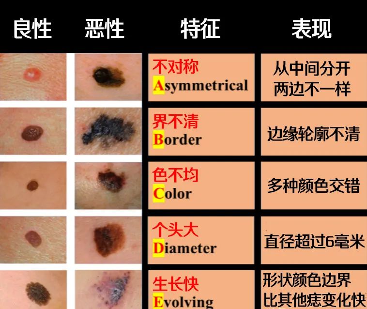 身上长痣可以用药水点吗,脸上的痣能随便点吗