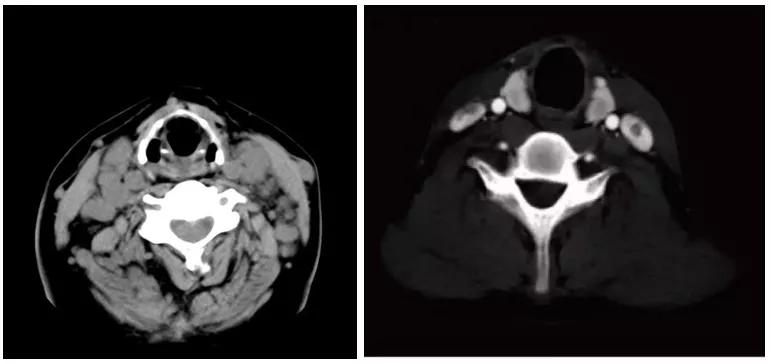 仑伐替尼降价药好用吗,2022年9月仑伐替尼价格会有变动吗