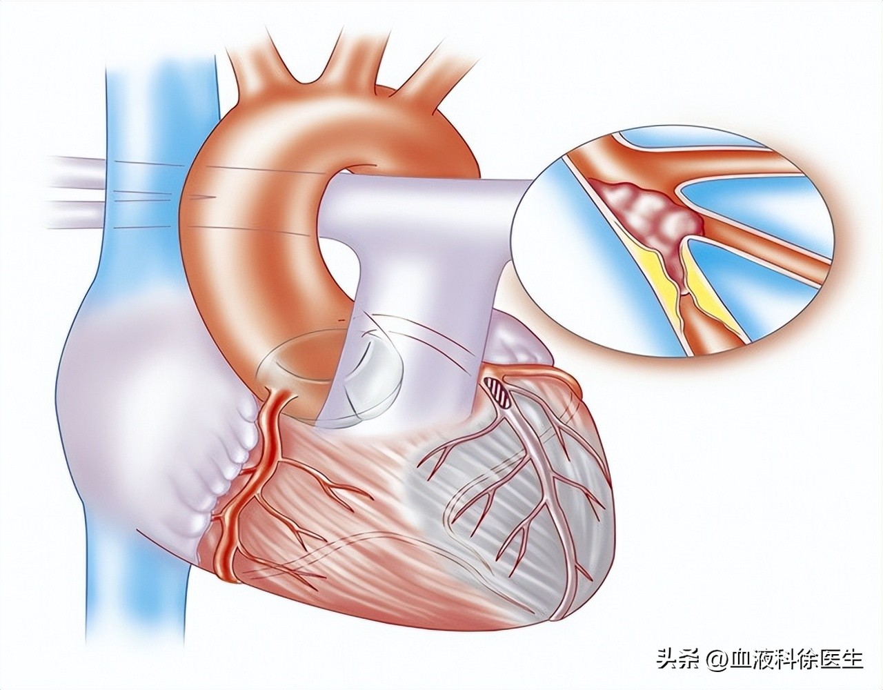 为什么脑血栓都是赌博惹的祸,为什么得了脑血栓会反复发高烧