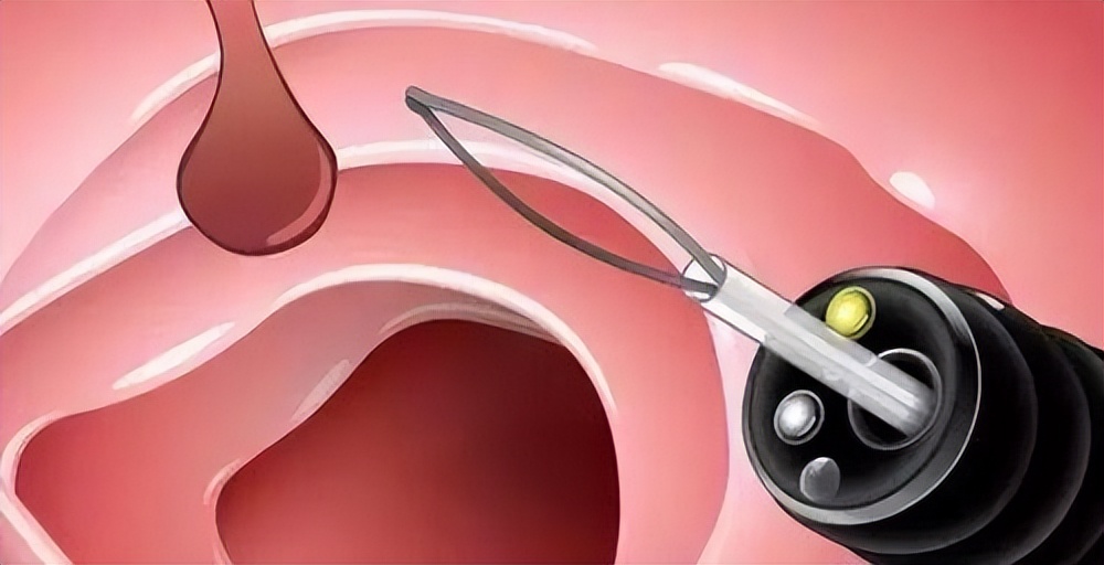 肠息肉切除后怎么避免再长,肠息肉切除后再长出来怎么办