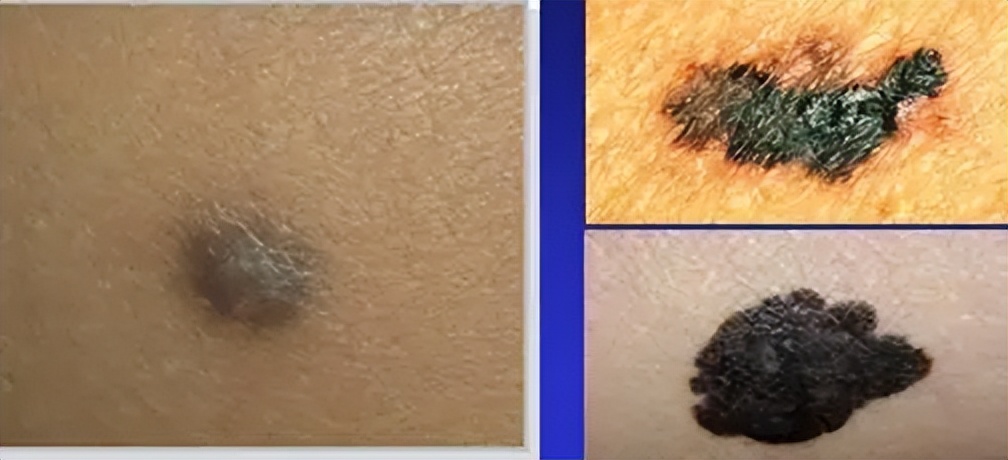 脚后跟长鸡眼严重性,脚后跟有个三四年的鸡眼