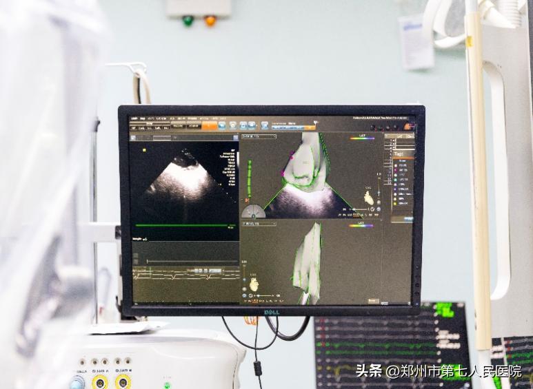 深入肌层心领未来|我院心内科完成河南省首例“零”射线下心内膜心肌活检术