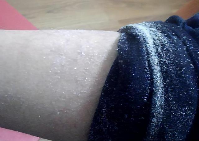 冬天皮肤干燥皮屑满天飞吃什么药,秋衣秋裤皮屑满天飞