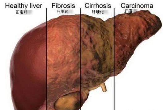肝囊肿如何护肝养肝,肝经淤堵脂肪肝