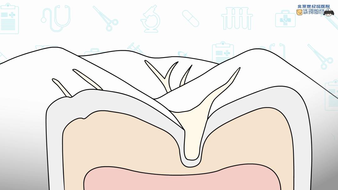 健康科普龋齿窝沟封闭,预防蛀牙科普视频