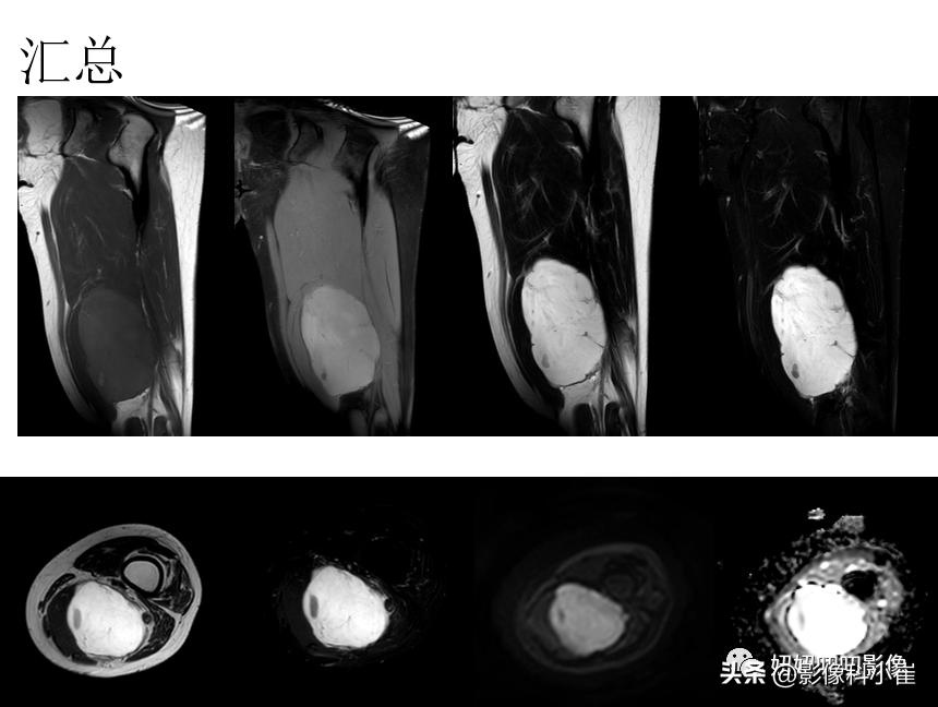 软组织肿块形成原因,软组织肿块怎么治最好