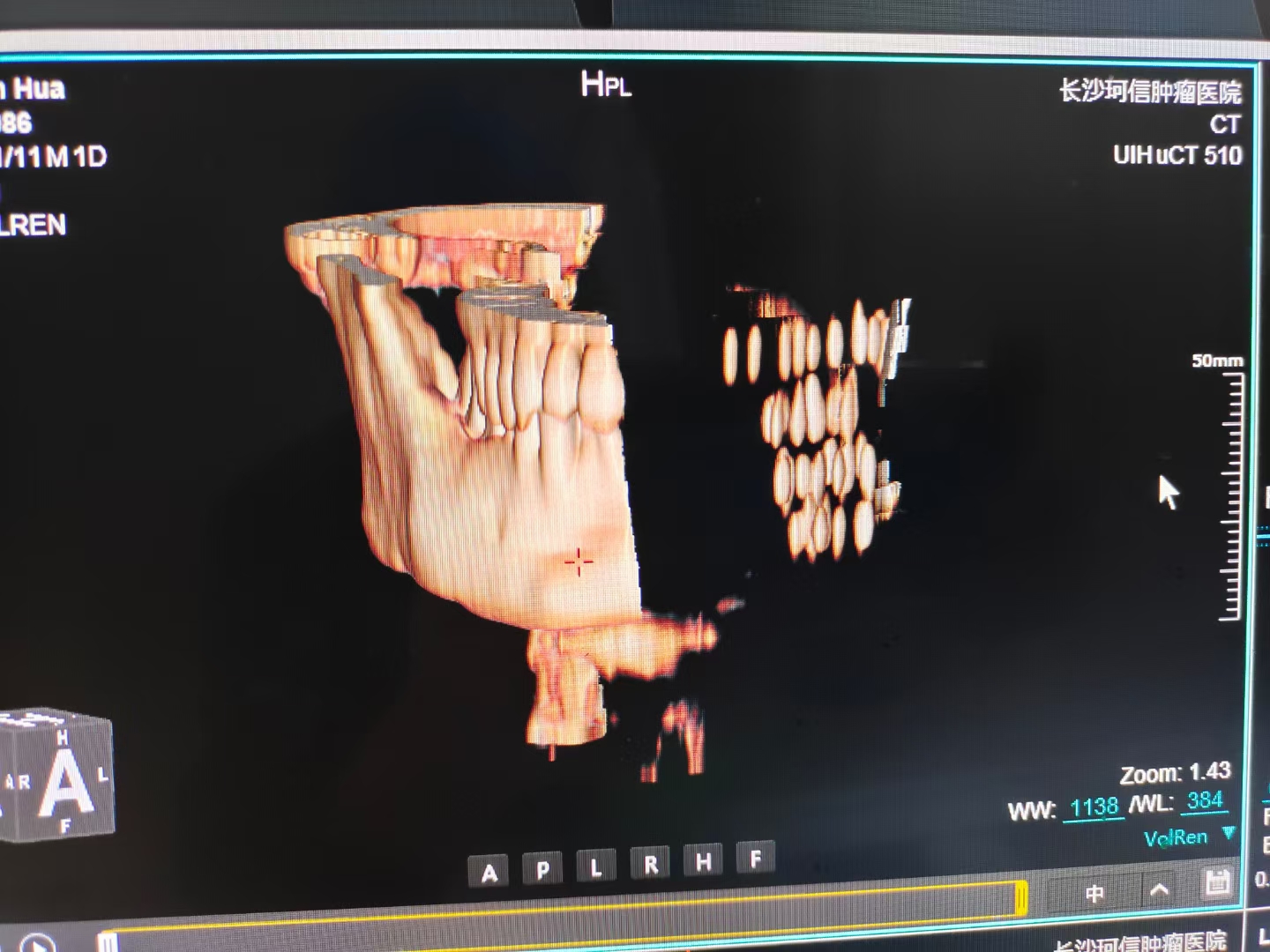 舌癌术后转移淋巴还能治吗,舌癌放疗后复发后怎么办