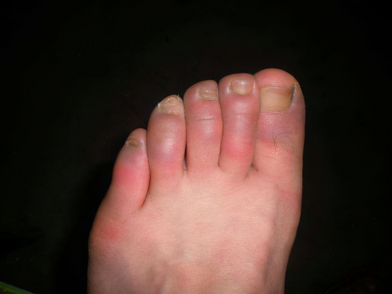 冬天手长冻疮怎么办,冬天为什么会长冻疮