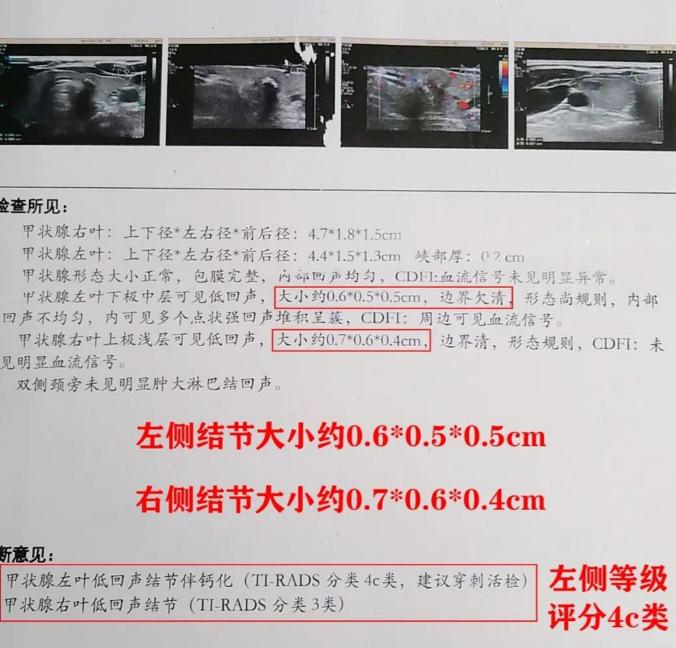 甲状腺球蛋白（Tg）高，就是甲状腺癌吗？