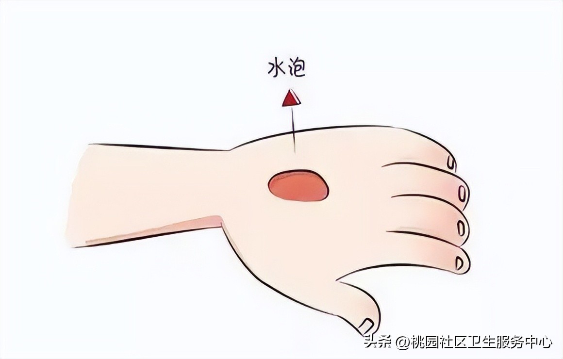 烫伤后抹牙膏怎么洗掉,烫伤涂牙膏酱油有什么作用