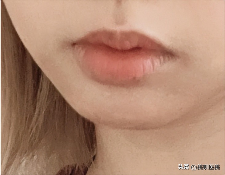 市面上假的玻尿酸打了会怎么样,假玻尿酸毁容案例