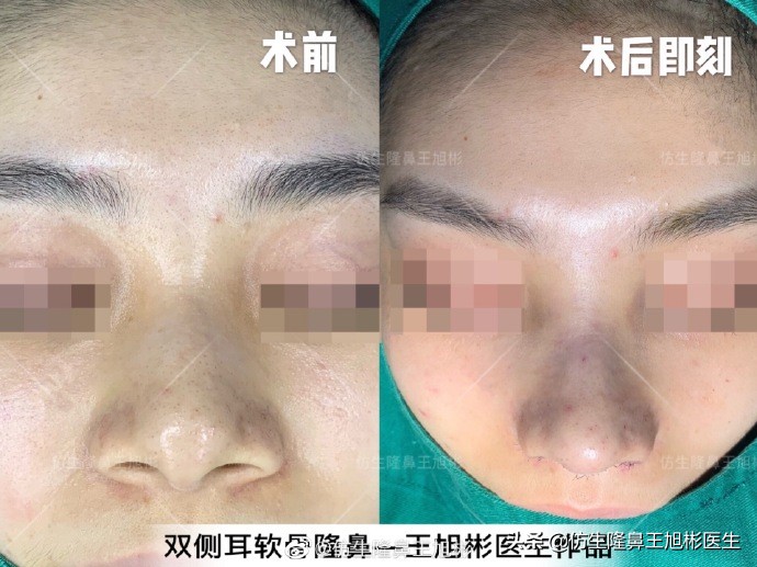 常见鼻部整形美容项目,整形鼻和自然鼻