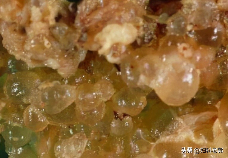 葡萄胎容易怀上怪胎吗,葡萄胎是不是怪胎