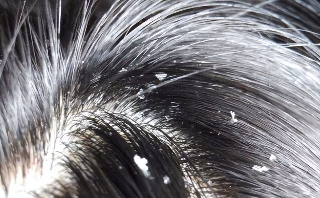 头皮上总是长疙瘩脓包是怎么回事,头皮上经常有疙瘩和脓包怎么回事