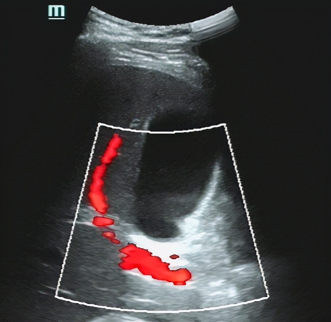 超声所见正常范围准确吗,超声看不清楚