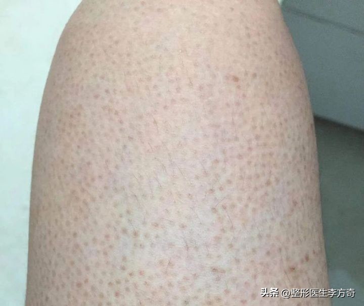 鸡皮疙瘩毛囊角化症怎么才能治好,毛囊角化鸡皮肤激光可以解决吗