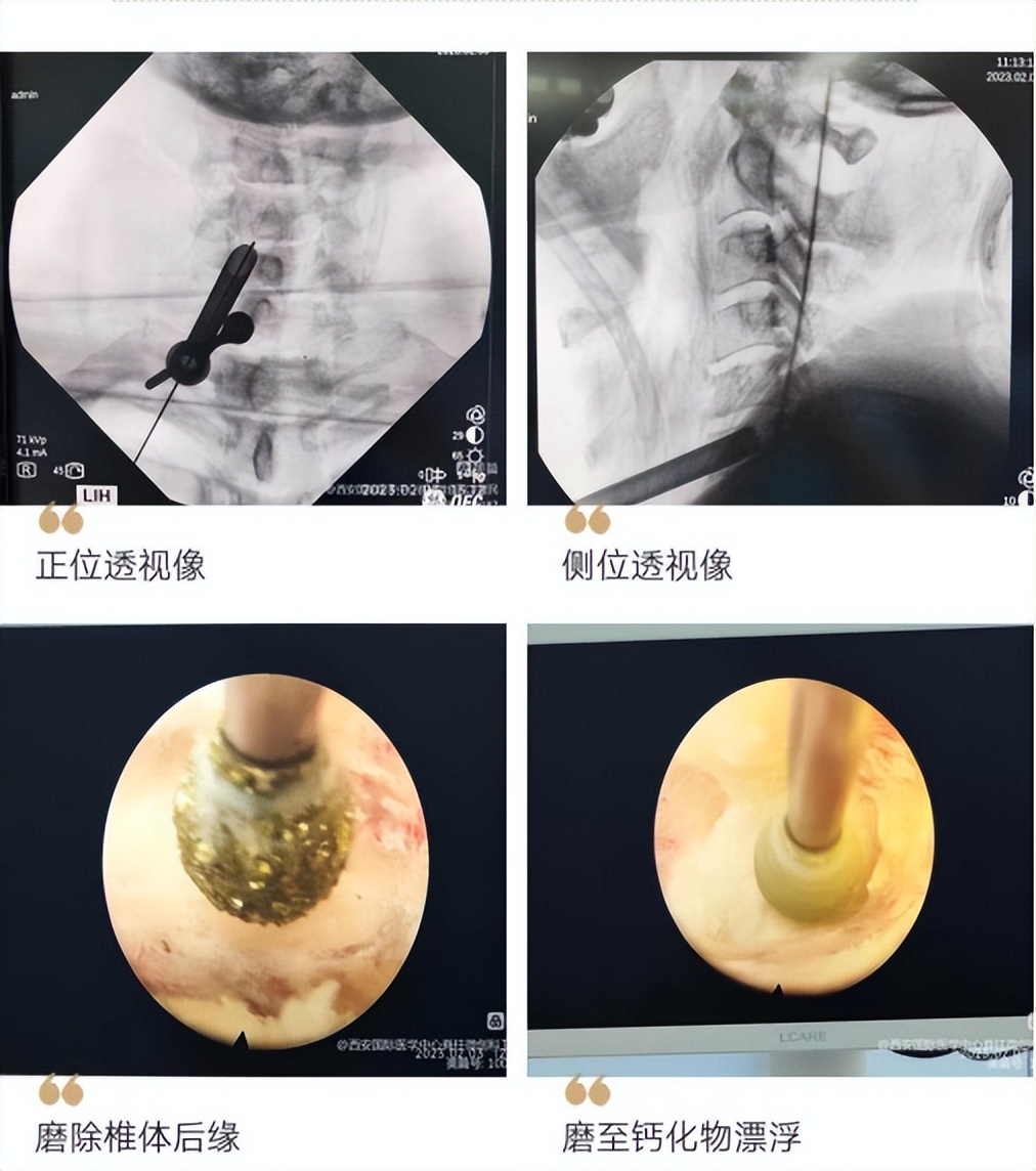颈椎后路内镜微创手术,颈椎韧带钙化手术切除全过程