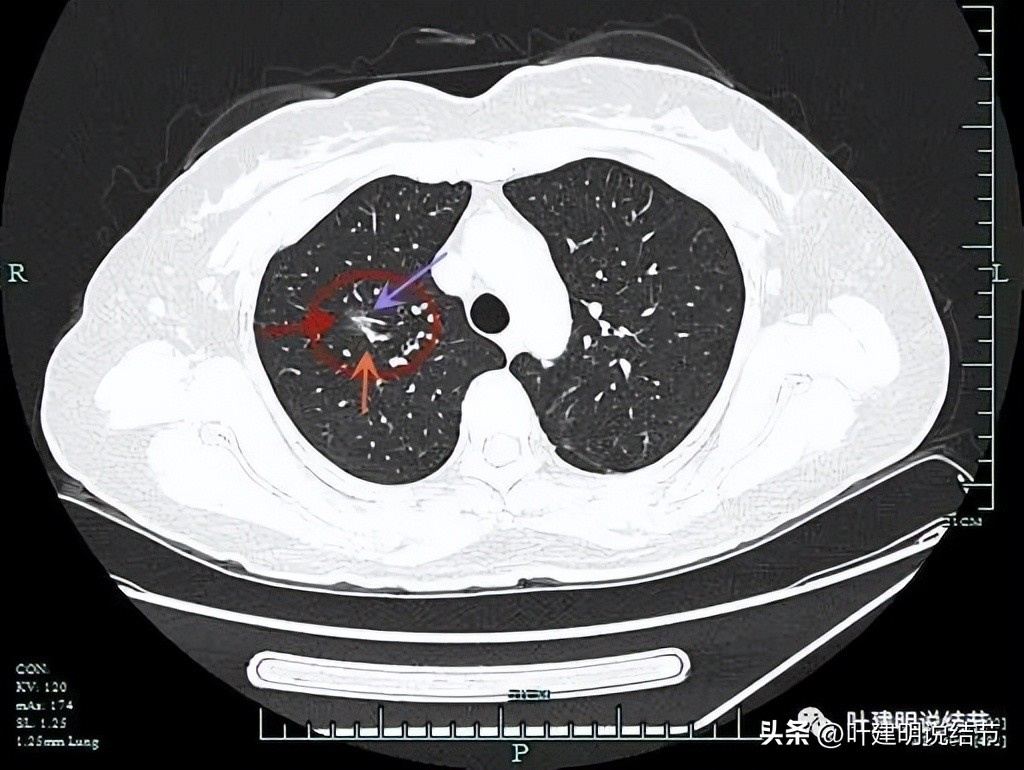 浙江肿瘤医院做肺结节手术多少钱,浙江省肿瘤医院肺结节微创手术
