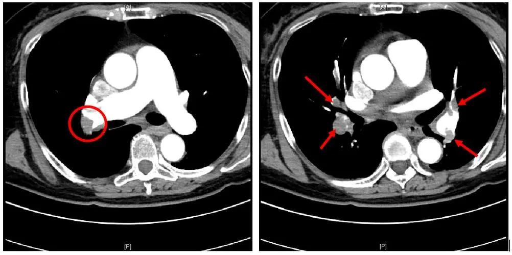 女子咳嗽咳出来肿瘤,女子咳血