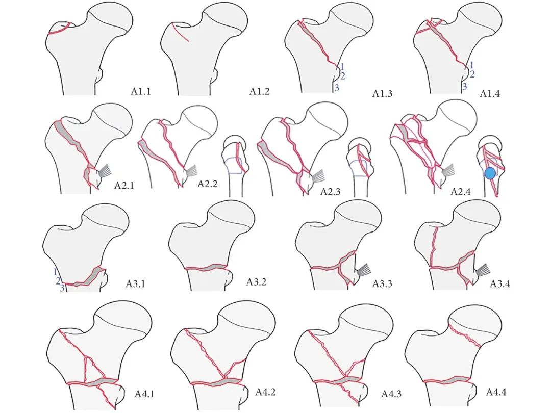 股骨转子间骨折四种手术方法比较,股骨转子间骨折属于轻伤还是重伤