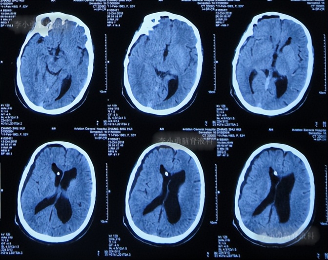 脑积水手术后4天还呕吐怎么回事,脑积水分流术后一直腹部疼痛