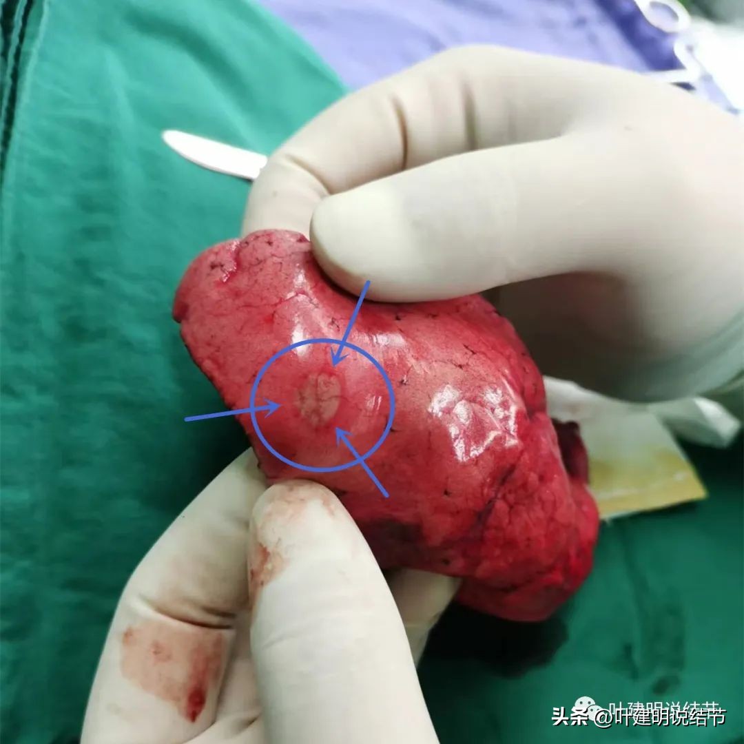 中叶多发微小结节,男性30岁右侧甲状腺单发结节