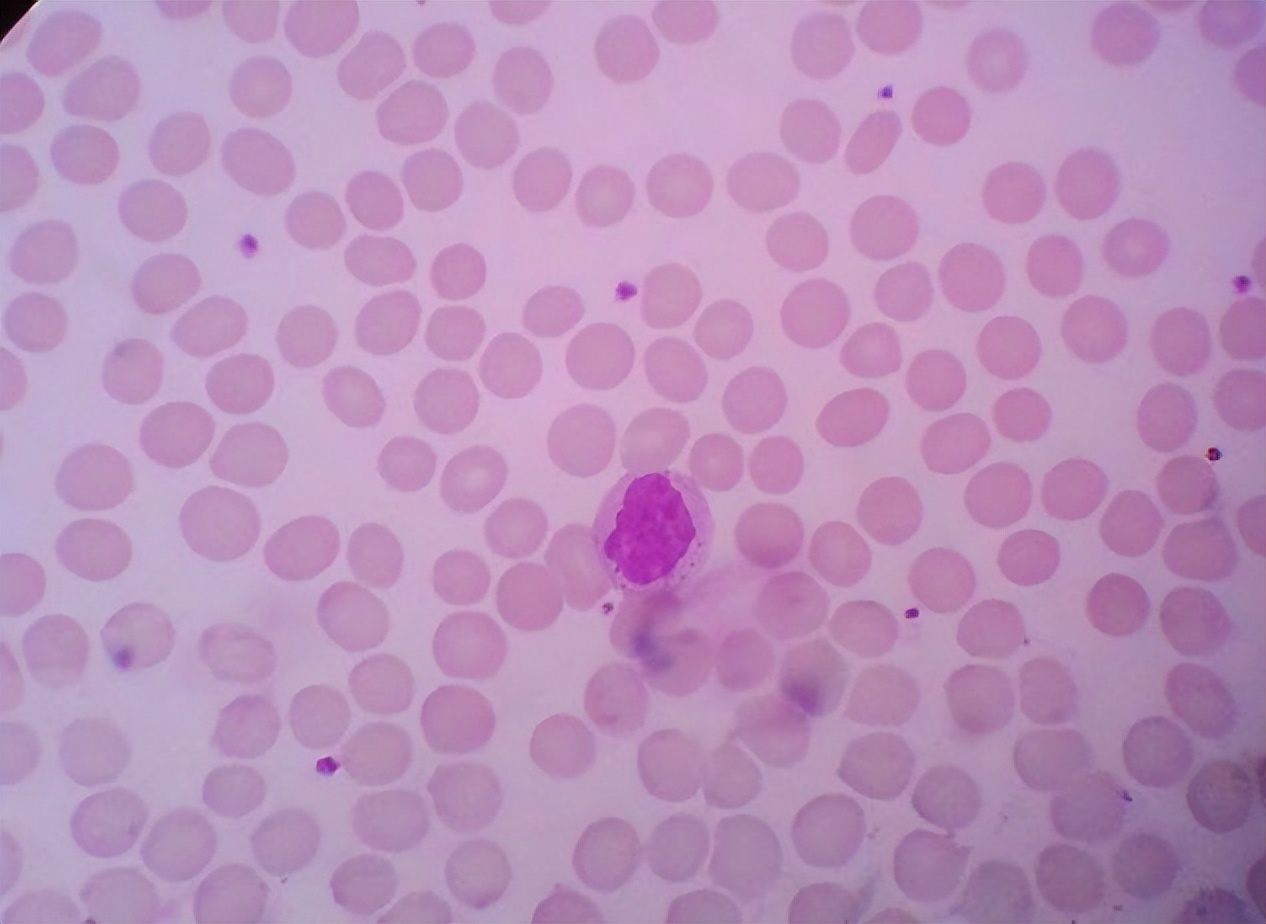 感染性发热血常规哪项指标升高,血常规检查的各项指标偏高