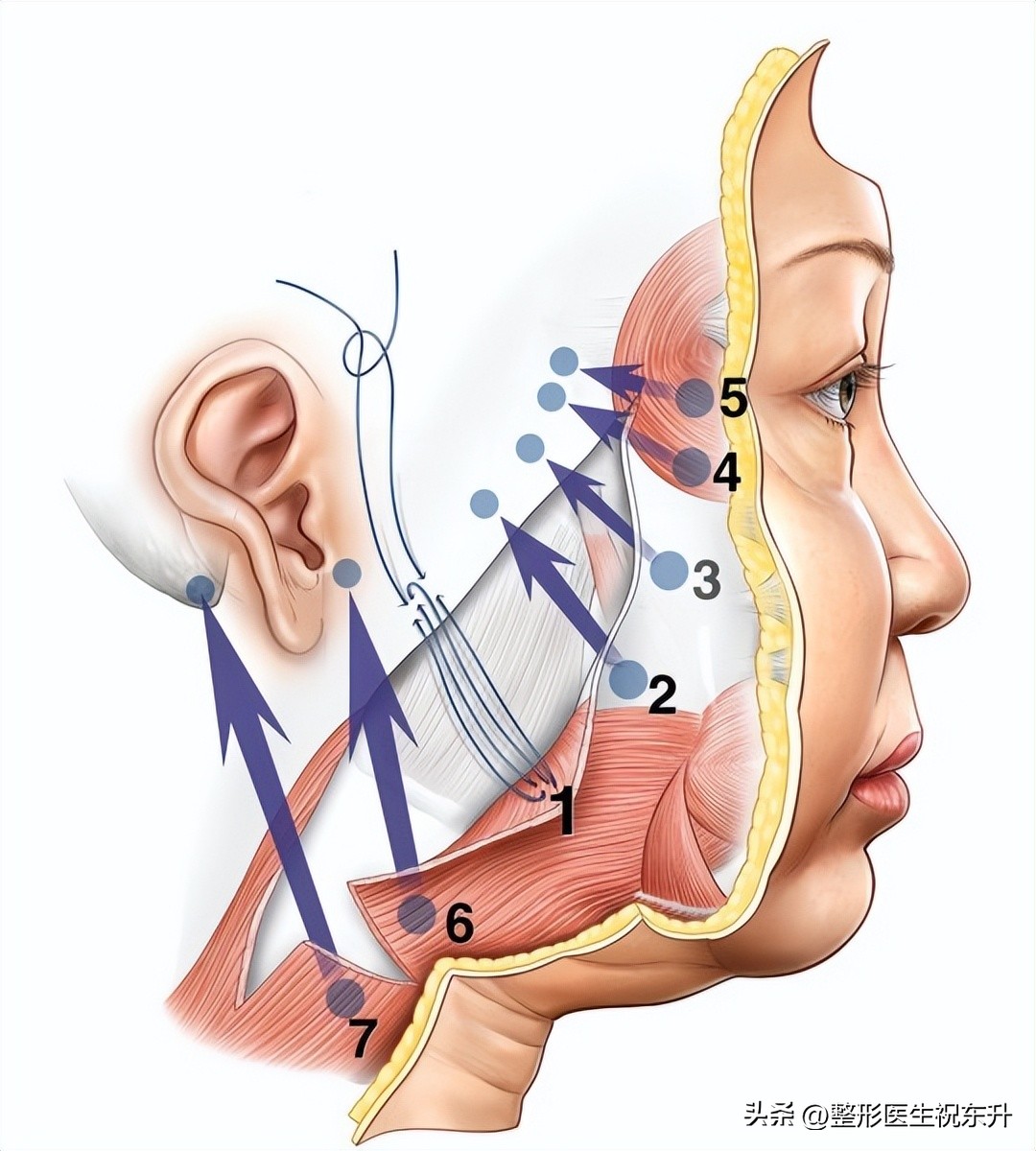嘴角木偶纹做拉皮手术可以消除吗,做拉皮手术口角纹怎么没去掉